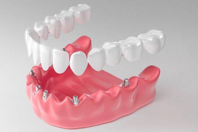 تخصص پروتزهای دندانی